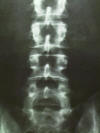 lumbar spine x ray; pedicle, lamina, vertebral body, facet joints, nerve