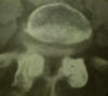 lumbar spine ct scan; pedicle, lamina, vertebral body, facet joints, nerve