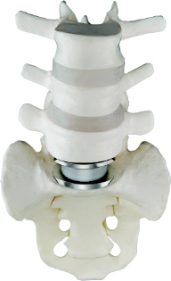 artificial disc, charite, disc, arthroplasty, low back pain, back pain, pain, leg pain, motion preservation, houston, texas, katy, river oaks, united states, usa, america,saudia arabia, dubai, britain, france, puerto rico, mexico, best doctors