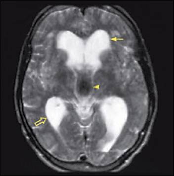 normal pressure hydrocephalus nph, houston, texas, united states