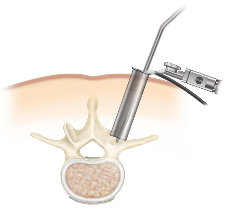 spine surgery through percutaneous tube