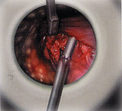 microscopic surgery of the spine