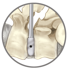 plif, tlif, lumbar interbody fusion