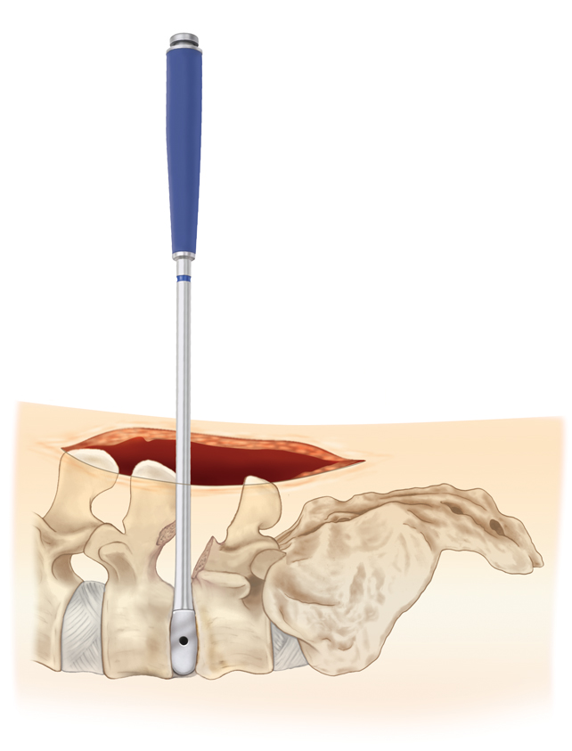 wiltse approach to spine surgery