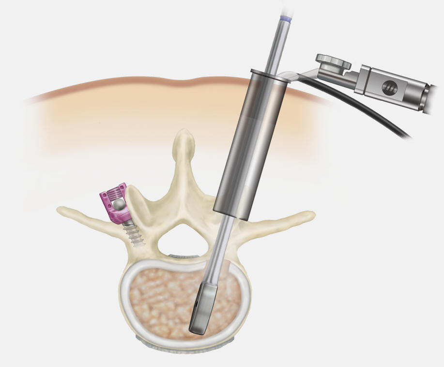 minimally invasive lumbar fusion