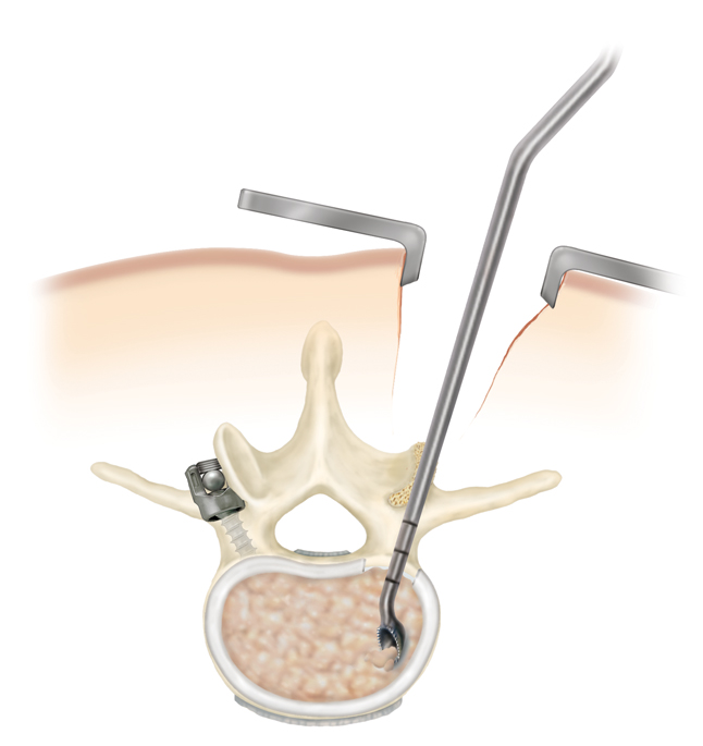 minimall invasive surgery