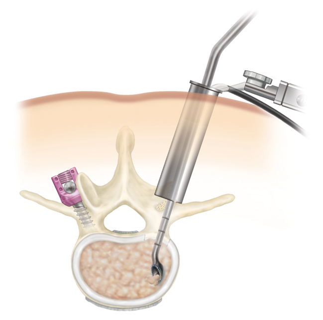 wiltse approach, minimally invasive spine surgery