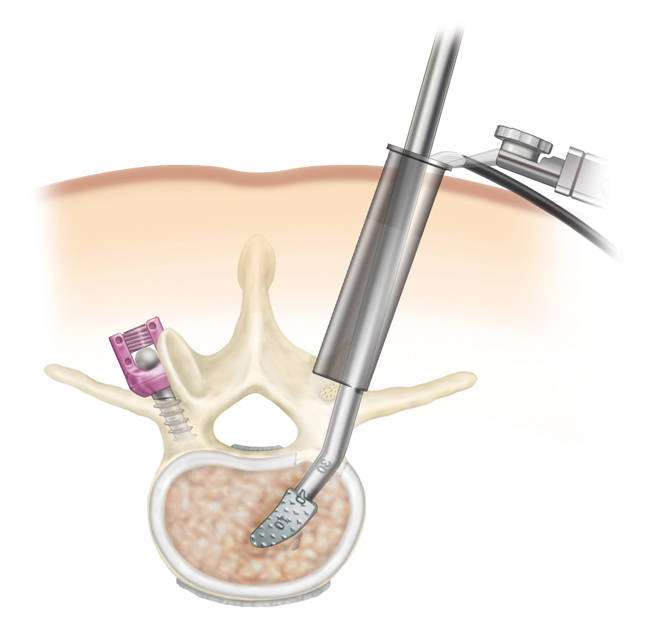 minimally invasive surgery of the spine