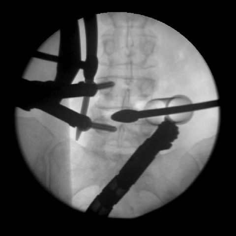 x ray minimally invasive low back surgery