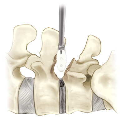 interbody graft, spine fusion