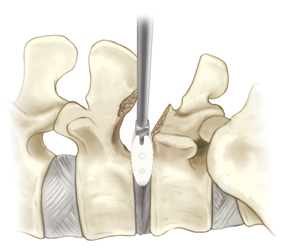 laminectomy, spine surgery, minimally invasive surgery