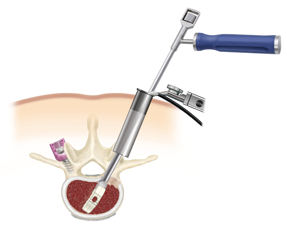 interbody fusion, graft, plif, tlif, pedicle screws