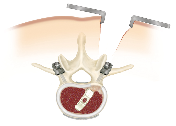 plif, interbody fusion, pedicle screws