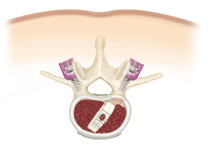 plif, pedicle screws, interbody fusion