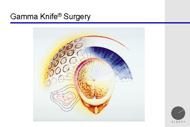 isodose lines of gamma knife plan, brain tumor