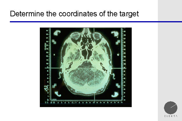 images of tumor, ct, brain tumor