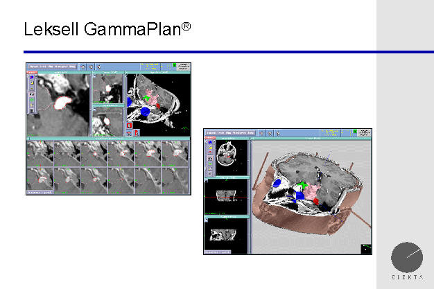 gamma knife planning station, tumor