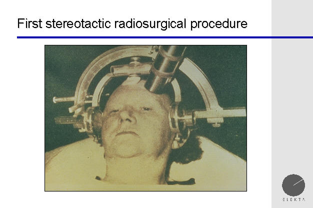 linear accelerator radiosurgery frame based