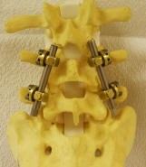 fusion of the lumbar spine; pedicle screws