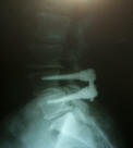 pedicle screws; fusion; lumbar x ray scan; low back pain