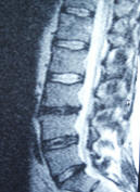 mri scan lumbar spine; low back pain