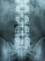 lumbar x ray scan; low back pain