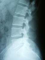 lumbar x ray scan; low back pain