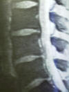 lumbar spine mri scan; pedicle, lamina, vertebral body, facet joints, nerve