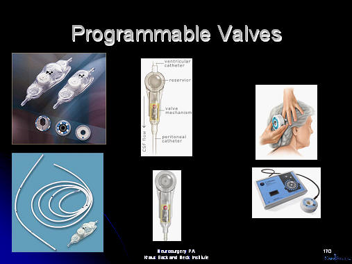 programmable valves; medtronic or codman