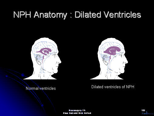 dilated ventricles in nph, houston, texas