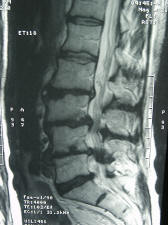 mri scan; lumbar spine; degenerative disc disease; low back pain