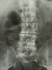 scoliosis; x ray scan; lumbar spine; low back pain