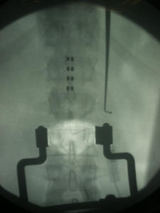 spinal cord stimulator (medtronic - mdt) surgery, houston, texas, west houston, river oaks, neurosurgeon, neurosurgery, surgery