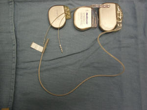 spinal cord stimulator (medtronic - mdt) surgery, houston, texas, west houston, river oaks, neurosurgeon, neurosurgery, surgery