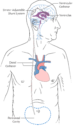 nph, normal pressure hydrocephalus, vp shunt, vp,  hydrocephalus,  houston,  texas