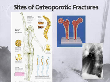 the spine (vertebral bodies), the femur and the wrist are most common locations for osteoporosis related fractures