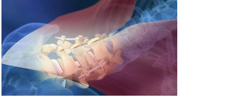 minimally invasive percutaneous placement of pedicle screws and rods with sextant, medtronic