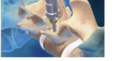 pedicle screw being placed with sextant, medtronic