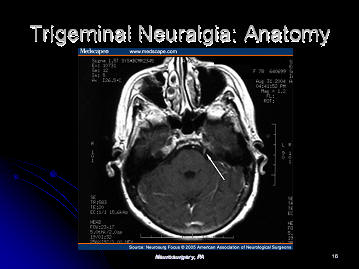mri scan of trigeminal nerve